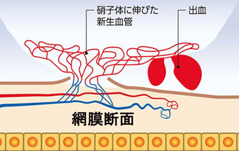 網膜新生血管による硝子体出血、網膜剥離