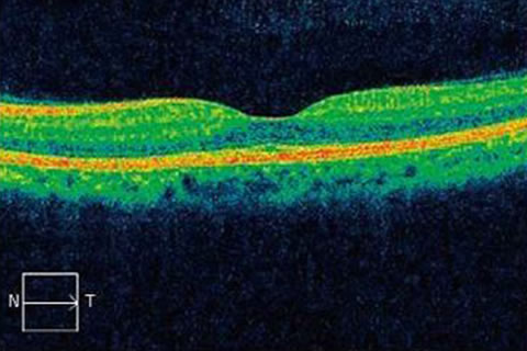 正常な黄斑の網膜断層像